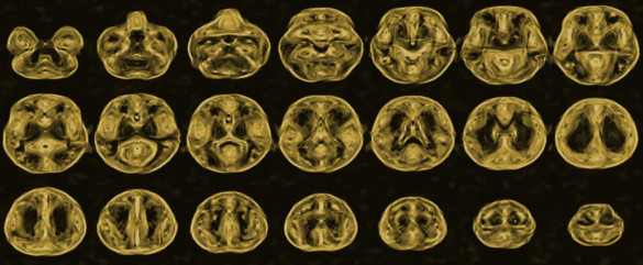 VG-weighted Brain Imaging | The Neuro Bureau